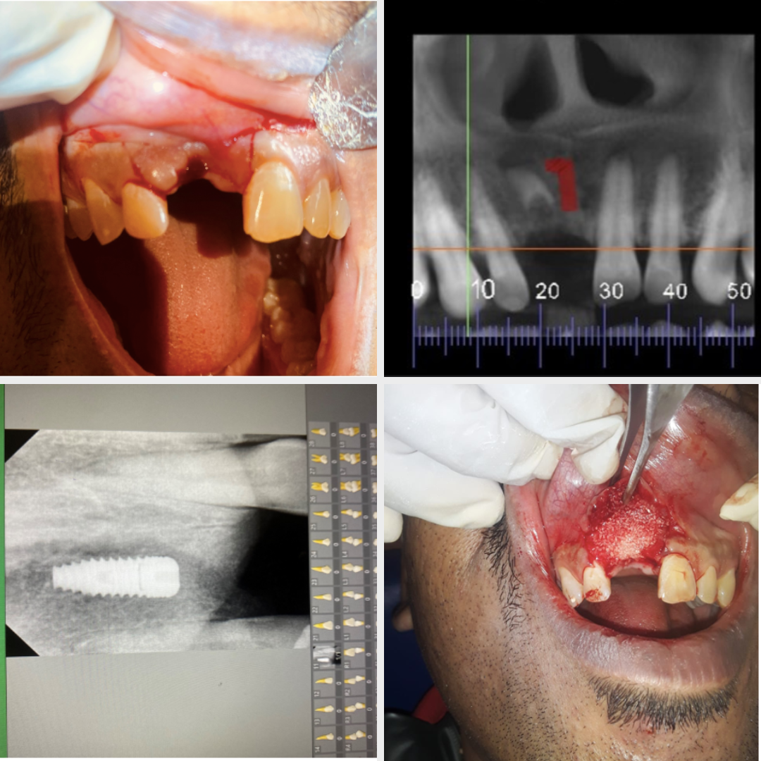 Dental Implant