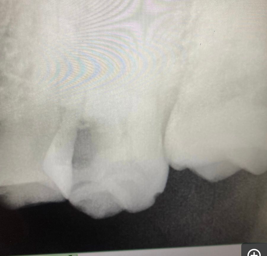 proximal caries involving pulp.