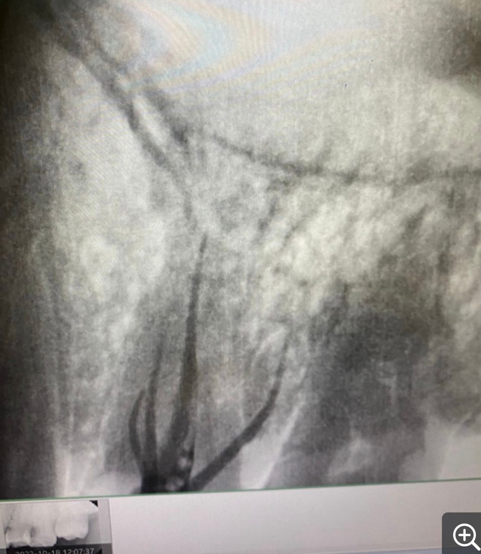 proximal caries involving pulp.