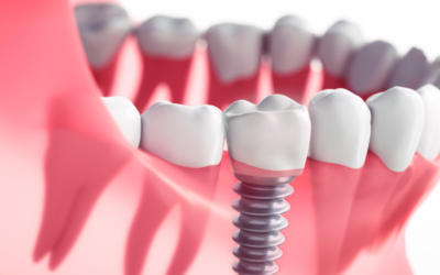 Transform Your Smile with Advanced Dental Implants