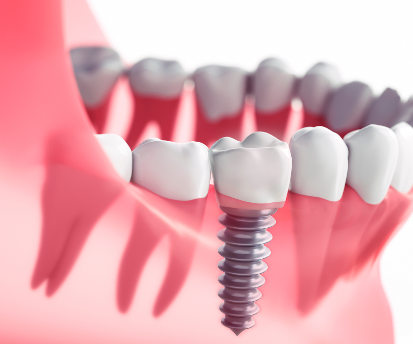 Transform Your Smile with Advanced Dental Implants