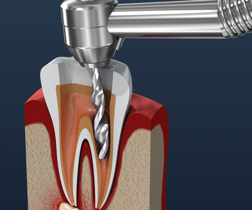 Single-sitting root Canal Treatment with aesthetic Crown