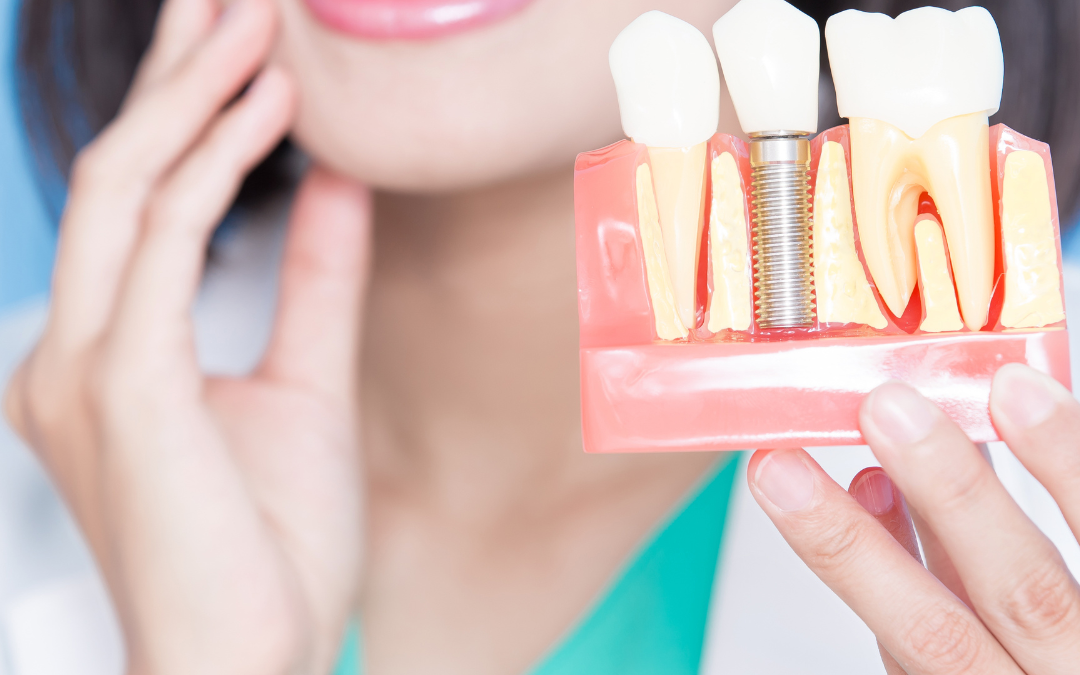 Revitalize Your Smile: The Extraordinary Impact of Advanced Dental Implants