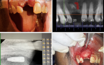 Dental Implant and Root Canal Treatment for Fractured Incisor