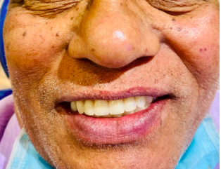 Improving Comfort and Retention with Implant Supported Overdentures